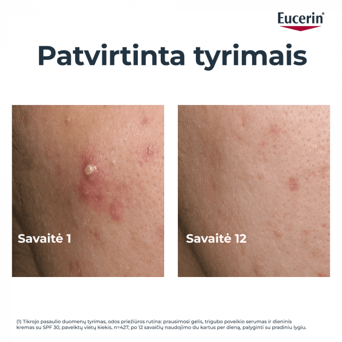 EUCERIN trigubo poveikio koreguojamasis fluidas riebiai, į aknę linkusiai odai DERMOPURE CLINICAL, 40 ml-1
