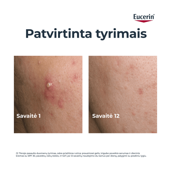 EUCERIN trigubo poveikio koreguojamasis fluidas riebiai, į aknę linkusiai odai DERMOPURE CLINICAL, 40 ml-1