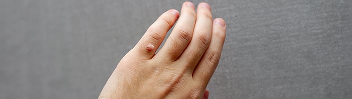 Atsirado karpa? Vaistininkė pataria, kokie turėtų būti pirmieji žingsniai