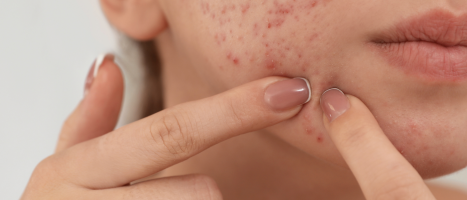 Streso iššaukta aknė rudenį: „Eurovaistinės“ grožio specialistė neigia mitą, kad negalima maskuoti aknės