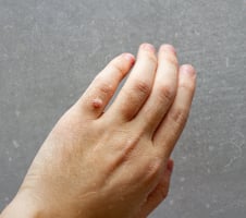 Atsirado karpa? Vaistininkė pataria, kokie turėtų būti pirmieji žingsniai