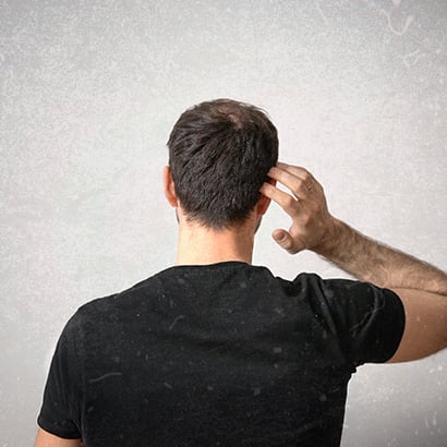 Žiemą atsirado daugiau pleiskanų? Sužinokite kodėl