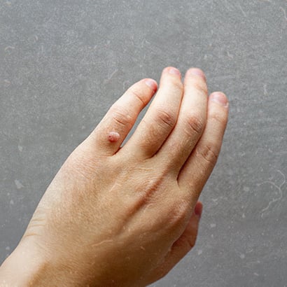 Atsirado karpa? Vaistininkė pataria, kokie turėtų būti pirmieji žingsniai